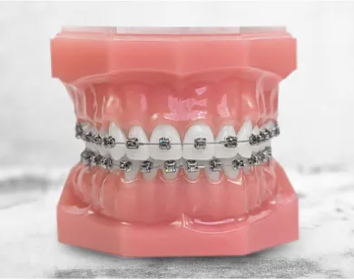 Close-up of metal braces placed over teeth, showing traditional orthodontic treatment