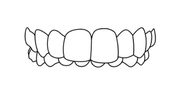 Patient with an overbite being treated with braces in Tijuana for a better smile