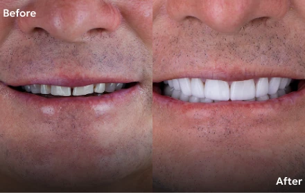 Before and after images of dental crowns in Tijuana