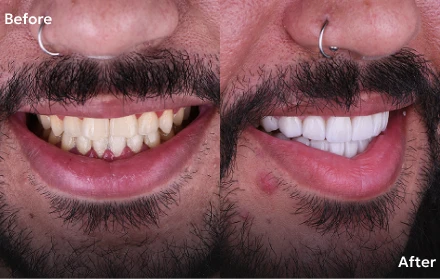 Dentist performing All-on-4 dental implant procedure in Tijuana
