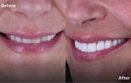 Before and after images of dental crowns in Tijuana