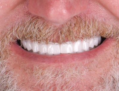Patient showcasing a transformed smile after a smile makeover.