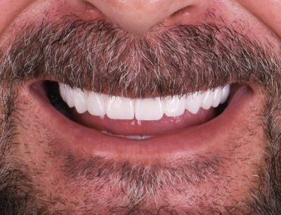 Patient smiling after root canal procedure at Tijuana dentist.