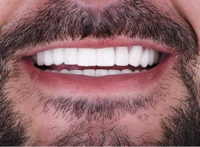 Patient smiling after dental crown procedure at Tijuana dentist.