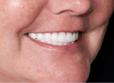 Patient smiling after dental crown procedure at Tijuana dentist.