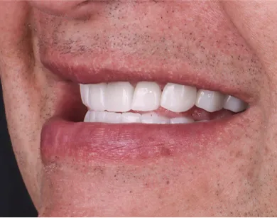 Image showing the improved appearance of teeth after veneers were applied in Tijuana.