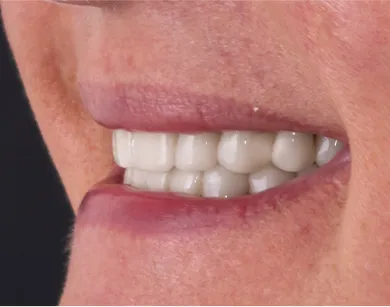 Close-up of e.max veneers applied to teeth, displaying durability and aesthetics from Tijuana clinic.