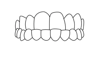 Underbite correction with braces in Tijuana, focusing on improving dental health and appearance.