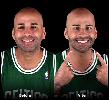 Veneers results before and after