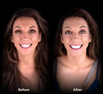 Veneers results before and after